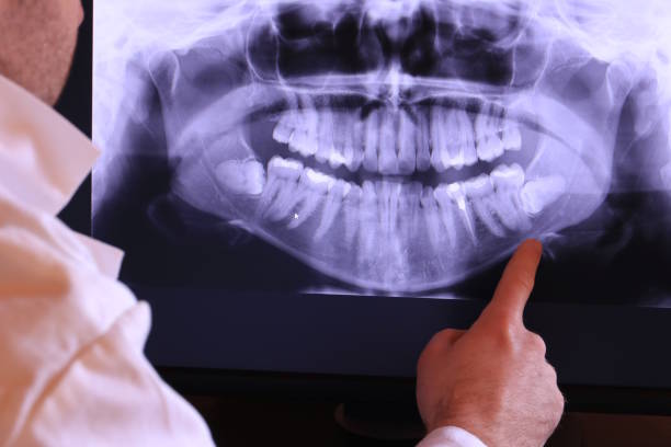 Best Knocked-Out Tooth (Avulsed Tooth) Treatment in Latta, OK